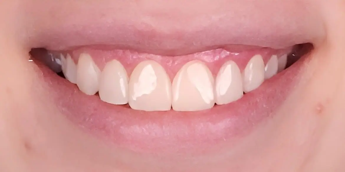 Lamine kaplama sonrası doğal duran bir gülüş